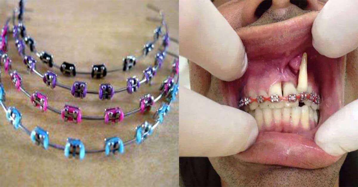 Boleh Membawa Kesan Sampingan, Inilah Sebab Anda Tak Boleh Menggunakan Fake Braces