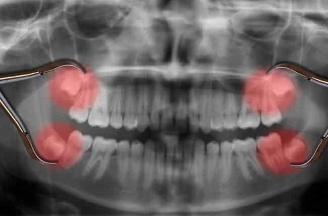 WisdomTeeth 650x428 1 7 Ciri-Ciri Unik Tubuh Badan Yang Anda Mungkin Ada Tetapi Tidak Dimiliki Oleh Orang Lain