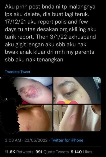Suami Dituduh Gigit Isteri Di Kuching Dilepaskan Dengan Ikat Jamin RM 4000