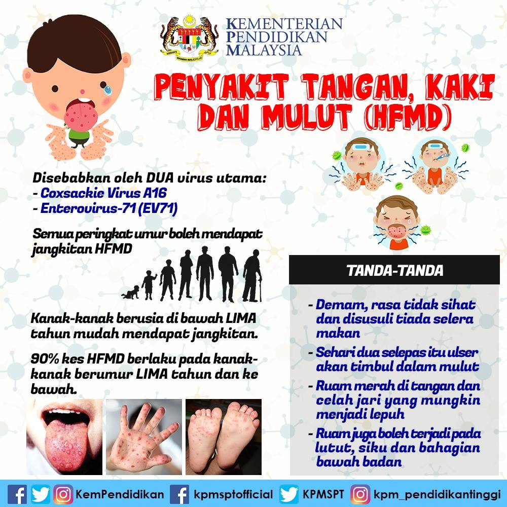Penyakit Tangan, Kaki Dan Mulut Meningkat 51 Kali Ganda Di Sabah Tahun Ini