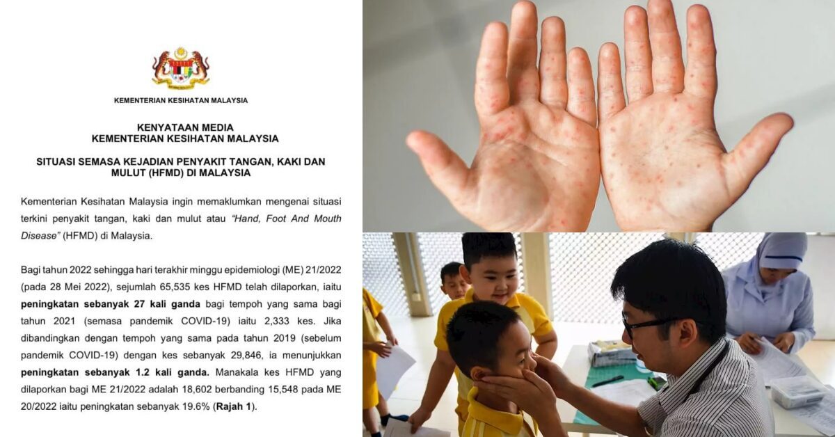 Semakin Mengganas, Ini Yang Perlu Dilakukan Ibu Bapa Sekiranya Anak-Anak Dijangkiti HFMD
