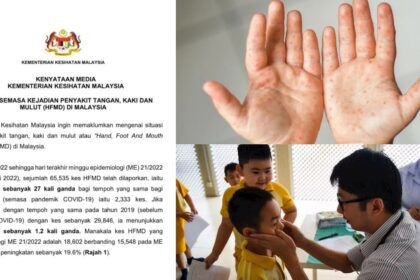 Semakin Mengganas, Ini Yang Perlu Dilakukan Ibu Bapa Sekiranya Anak-Anak Dijangkiti HFMD