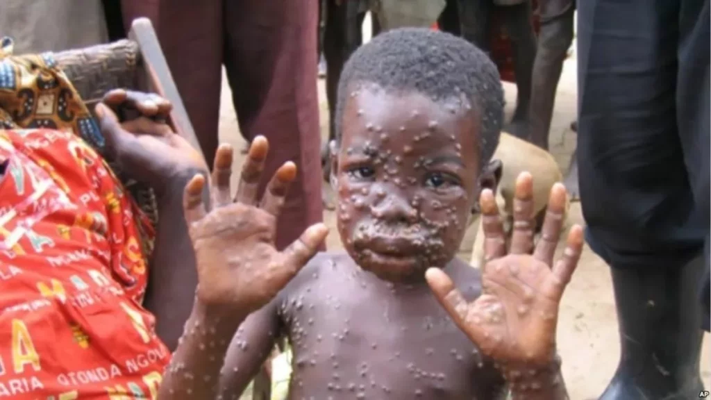 Wabak Monkeypox Menular Pantas, Pakar Dakwa Berpunca Daripada Festival Homoseksual