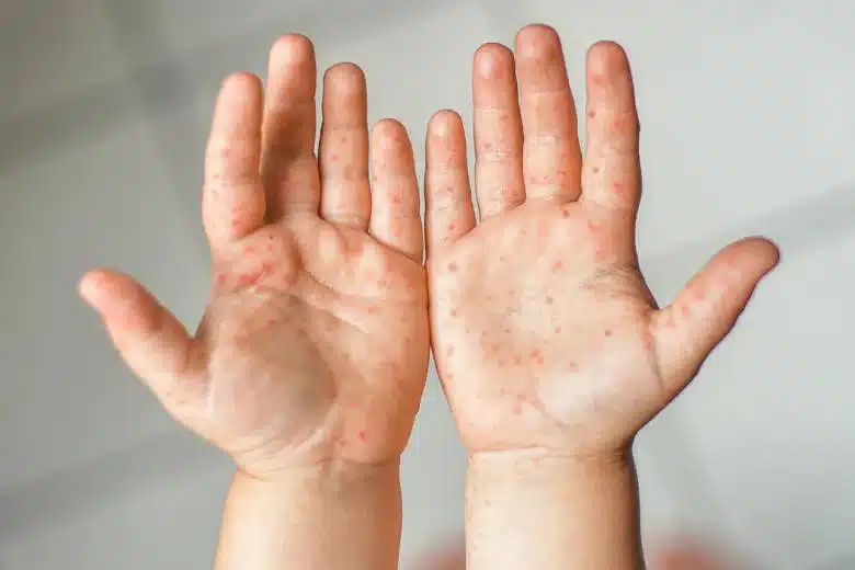 Semakin Mengganas, Ini Yang Perlu Dilakukan Ibu Bapa Sekiranya Anak-Anak Dijangkiti HFMD