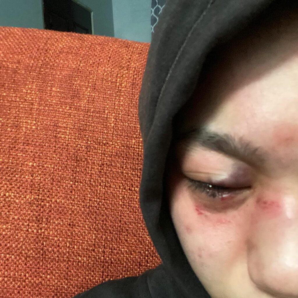 Jadi 'Punching Bag' Bapa Tiri, Gadis Dedah Didera Sampai Hampir Buta