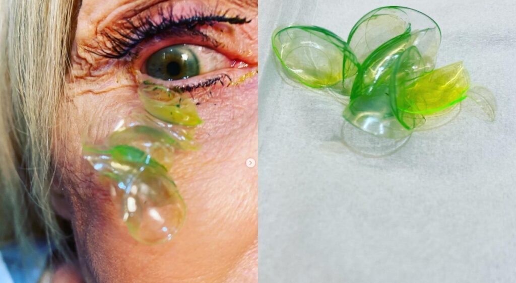 [VIDEO] Doktor Temui 23 Contact Lens Dalam Mata Akibat Lupa Tanggal