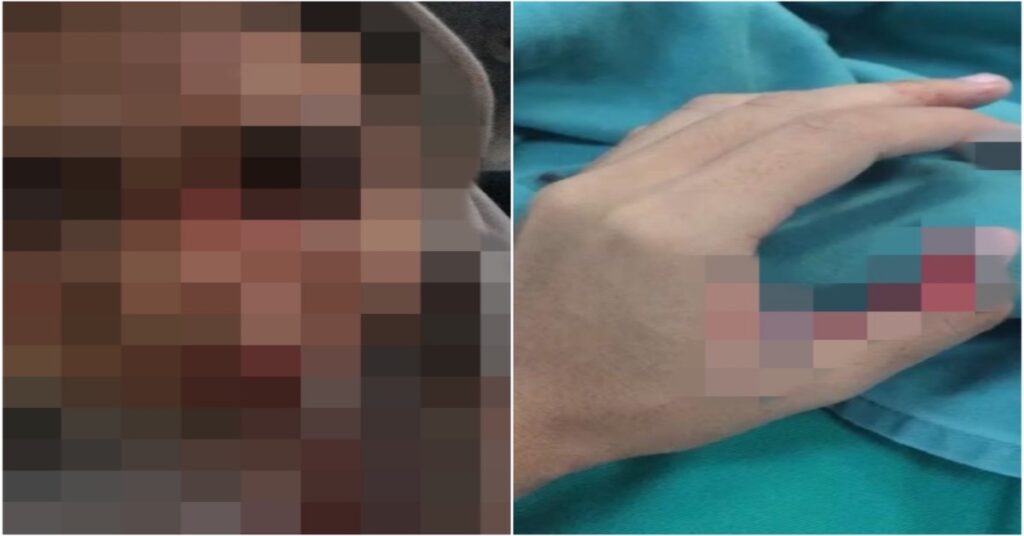 Hampir Hilang Penglihatan, Remaja Cedera Tersangkut Benang Kaca Di Kuching