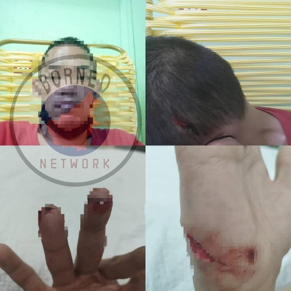 Padah Enggan Bayar Hutang Rakan, Lelaki Cedera Parah Kepala Ditukul Dan Ditetak Di Kuching