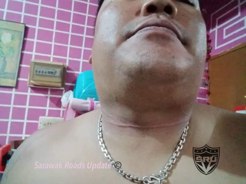 Semakin Menjadi-Jadi, Lelaki Cedera Pada Bahagian Leher Terkena Tali Gudi Di Jalan Tol Kuching