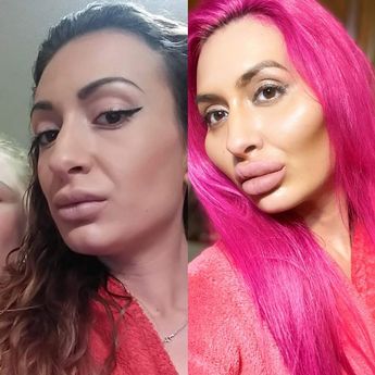 Berhabis Ribuan Pound Buat Muka, Model Terkenal Tak Kisah Pipi Besar Dan Pelik