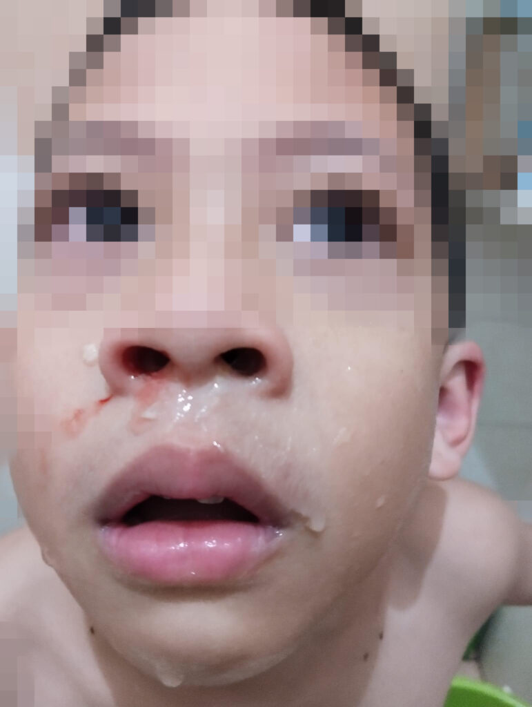 Anak Kerap Mengadu Pening, Sakit Kepala Dan Badan Terasa Panas