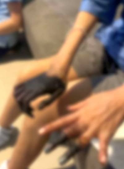 Jari Tangan Dan Kaki Wanita Menjadi Hitam Akibat Cirit-birit, Sampai Terpaksa Potong