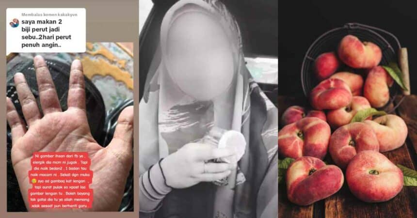 'Muka Pedih Dan Nafas Sesak', Wanita Kongsi Nyawa Hampir Melayang Lepas Makan Donut Peach Viral