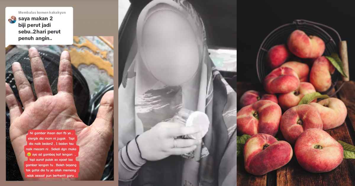 'Muka Pedih Dan Nafas Sesak', Wanita Kongsi Nyawa Hampir Melayang Lepas Makan Donut Peach Viral