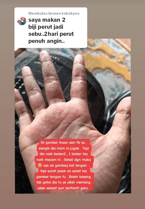 'Muka Pedih Dan Nafas Sesak', Wanita Kongsi Nyawa Hampir Melayang Lepas Makan Donut Peach Viral