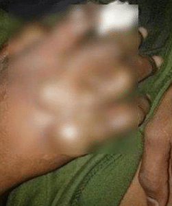 Pelajar Meraung Tangan Melepuh, Dakwa Guru Celup Dalam Air Mendidih Di Asrama