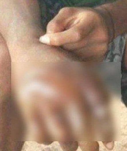 Pelajar Meraung Tangan Melepuh, Dakwa Guru Celup Dalam Air Mendidih Di Asrama