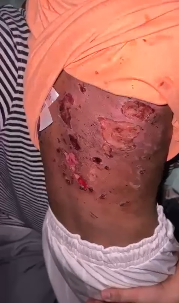 Badan Berlubang, Anak 7 Tahun Jadi Mangsa Dera Ibu Dan Housemate Pengkid