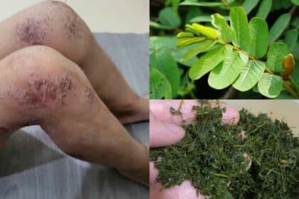 Wanita Ini Kongsi 'Keajaiban' Daun Gelenggang Sebagai Penyembuh Rawatan Kulit