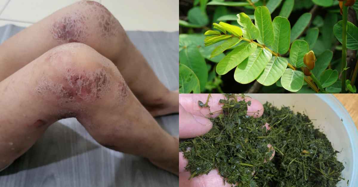 Wanita Ini Kongsi 'Keajaiban' Daun Gelenggang Sebagai Penyembuh Rawatan Kulit