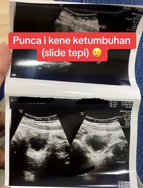 Gemar Makan Ayam Setiap Hari, Wanita Menghidapi Cyst Stage 3 Dan Hampir Operate RM30K