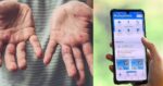 Siap Sedia Hadap Wabak Mpox, Pakar Cadang Penggunaan MySejahtera Semula