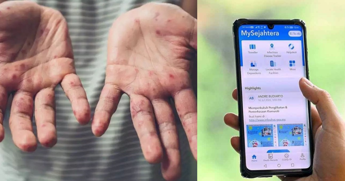 Siap Sedia Hadap Wabak Mpox, Pakar Cadang Penggunaan MySejahtera Semula
