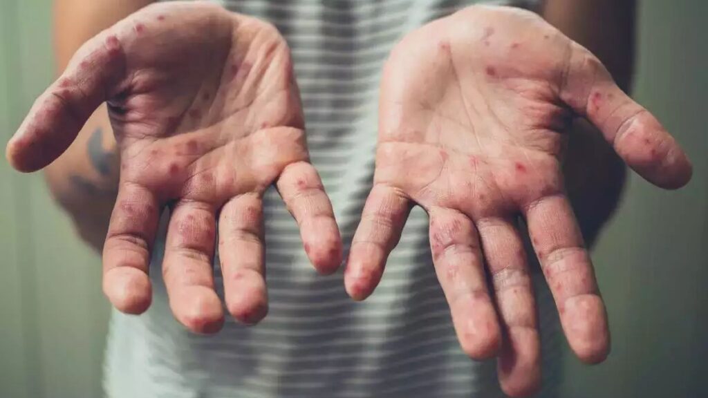 Ini Gejala Pesakit Hidap Mpox Menurut Kenyataan KKM