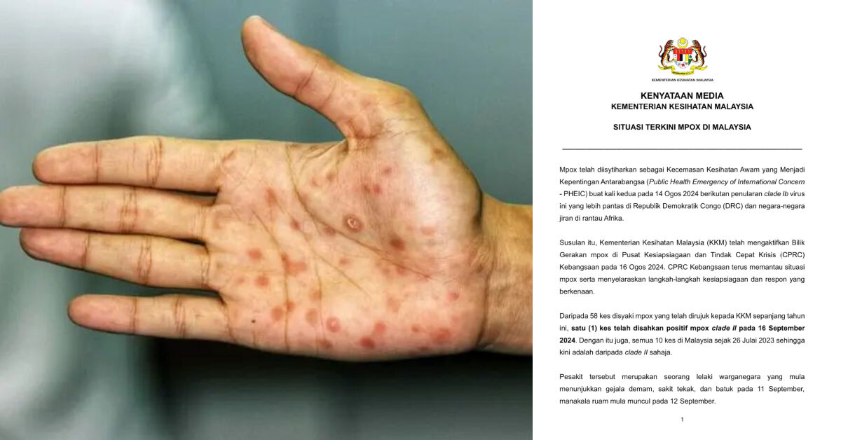 Ini Gejala Pesakit Hidap Mpox Menurut Kenyataan KKM
