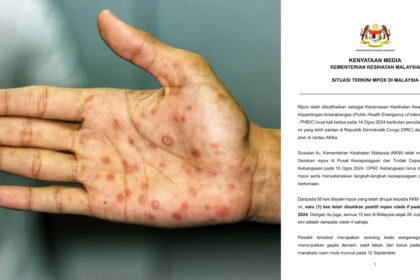 Ini Gejala Pesakit Hidap Mpox Menurut Kenyataan KKM