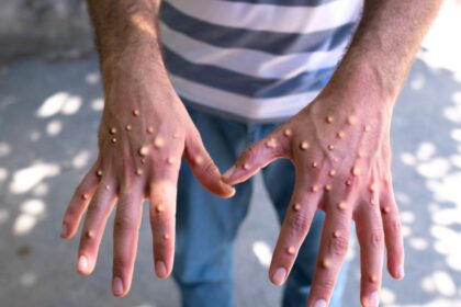 Rakyat Dinasihatkan Berjaga-Jaga, Kes Pertama Mpox Dikesan Di Malaysia