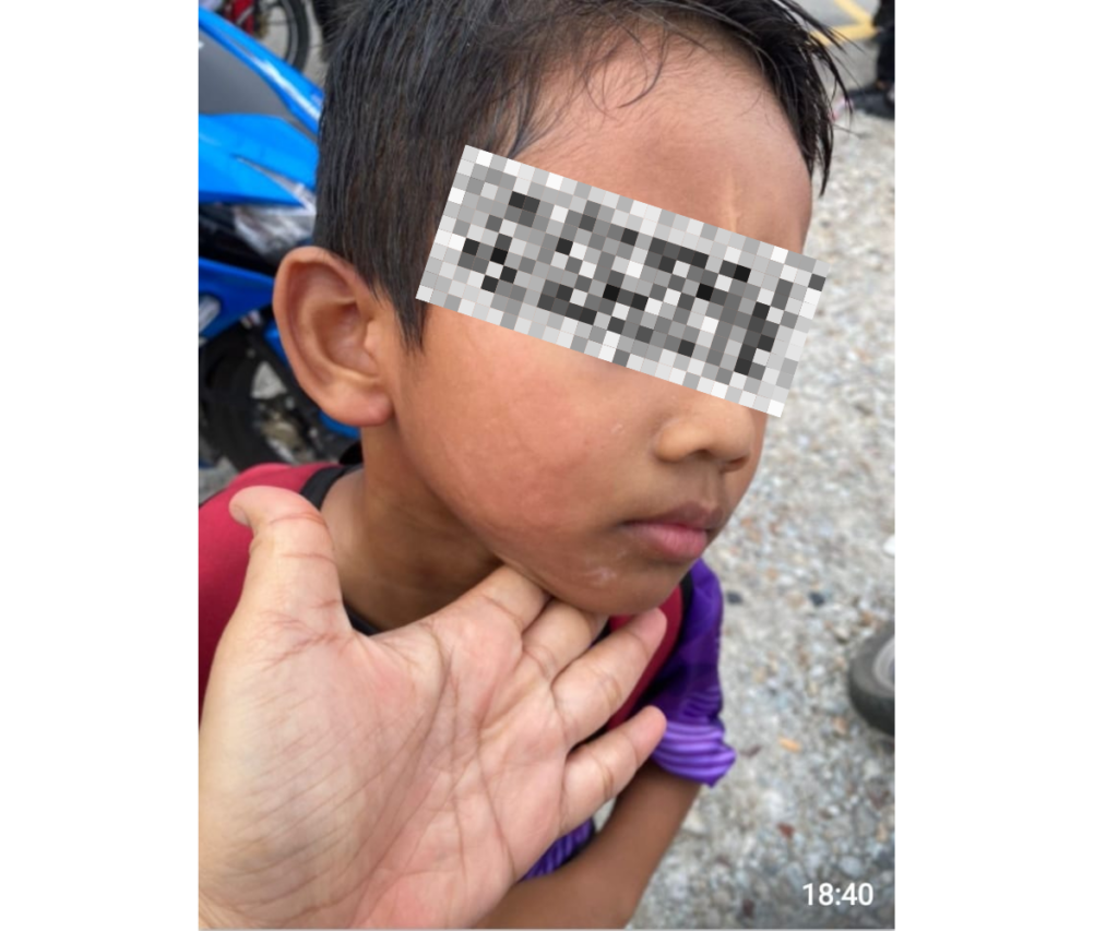 Anak Ditampar Kuat Di Pipi Gara-Gara Salah Masuk Barisan, Ibu Buat Laporan Polis Terhadap Guru