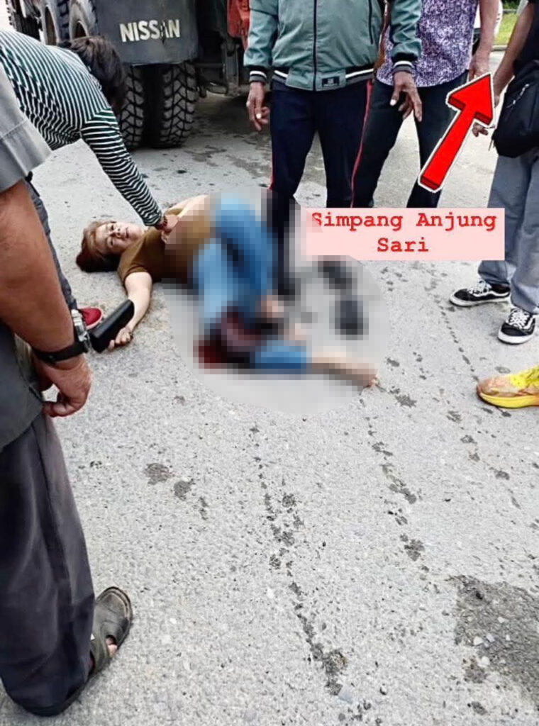 Tular Wanita Dilanggar Lori Di Lawas Hingga Putus Kaki, Mahukan Keadilan
