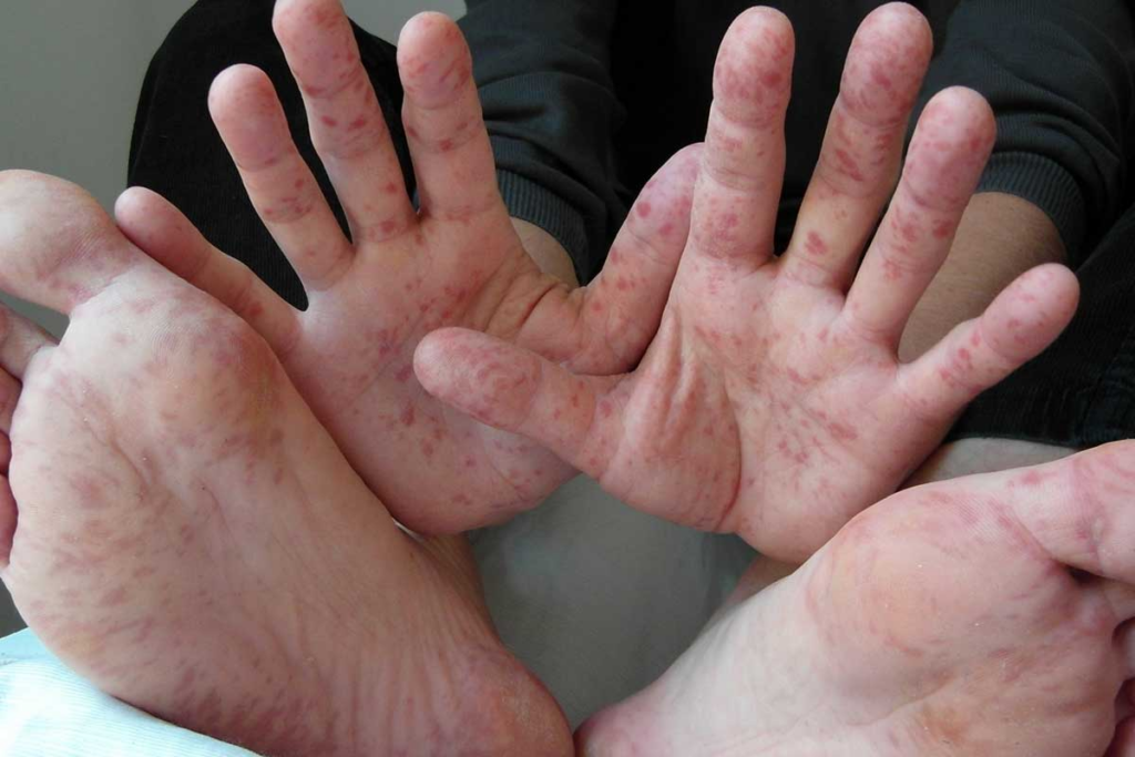 Kota Kinabalu Catat Kes HFMD Tertinggi, Sekolah Terpaksa Ditutup